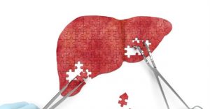 Non-invasive scan for liver disease